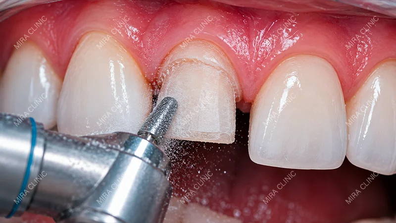 Tooth Preparation
